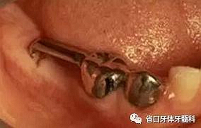 【牙医学堂】间隙保持器的介绍  