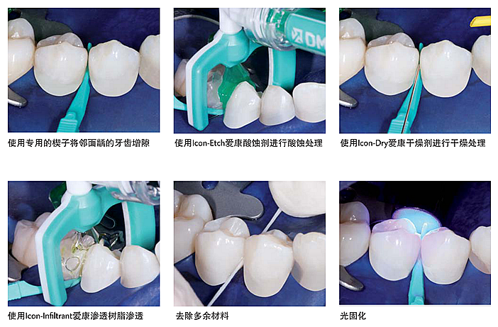  lcon爱康渗透树脂——邻面龋系列应用