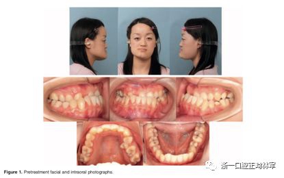 文献优秀正畸病例赏析-髁突增生性面部不对称的协同治疗1例
