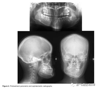 文献优秀正畸病例赏析-髁突增生性面部不对称的协同治疗1例