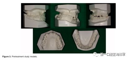 文献优秀正畸病例赏析-髁突增生性面部不对称的协同治疗1例