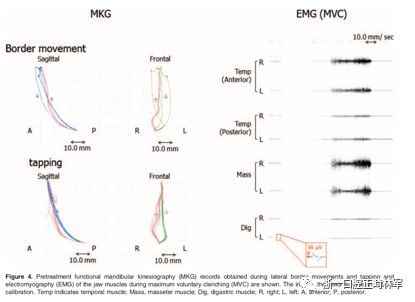 文献优秀正畸病例赏析-髁突增生性面部不对称的协同治疗1例