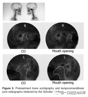 文献优秀正畸病例赏析-髁突增生性面部不对称的协同治疗1例