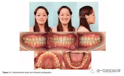 文献优秀正畸病例赏析-髁突增生性面部不对称的协同治疗1例