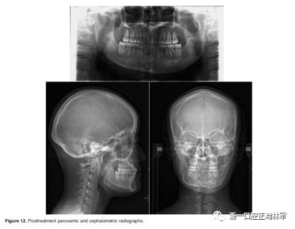 文献优秀正畸病例赏析-髁突增生性面部不对称的协同治疗1例