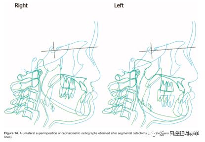 文献优秀正畸病例赏析-髁突增生性面部不对称的协同治疗1例