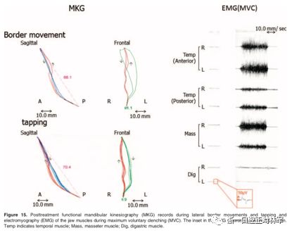 文献优秀正畸病例赏析-髁突增生性面部不对称的协同治疗1例