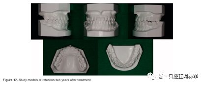 文献优秀正畸病例赏析-髁突增生性面部不对称的协同治疗1例