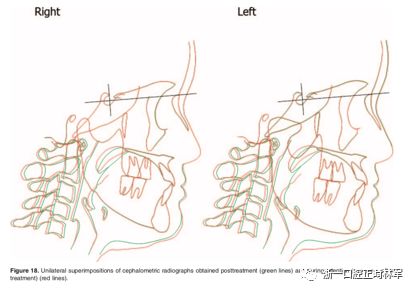 文献优秀正畸病例赏析-髁突增生性面部不对称的协同治疗1例