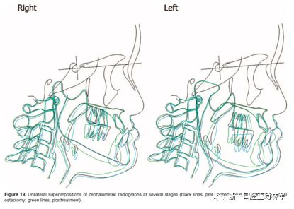 文献优秀正畸病例赏析-髁突增生性面部不对称的协同治疗1例