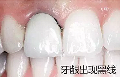 烤瓷牙出现问题【不要犹豫】尽快去医院拆除! 烤瓷牙出现问题【不要犹豫】尽快去医院拆除!